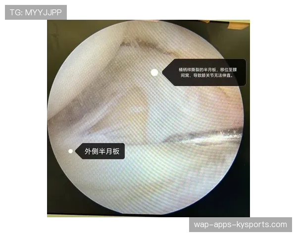 膝盖半月板撕裂后的关节卡顿声，半月板撕裂膝盖疼